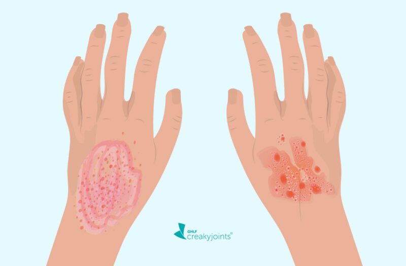Image of hand with eczema and hand with psoriasis