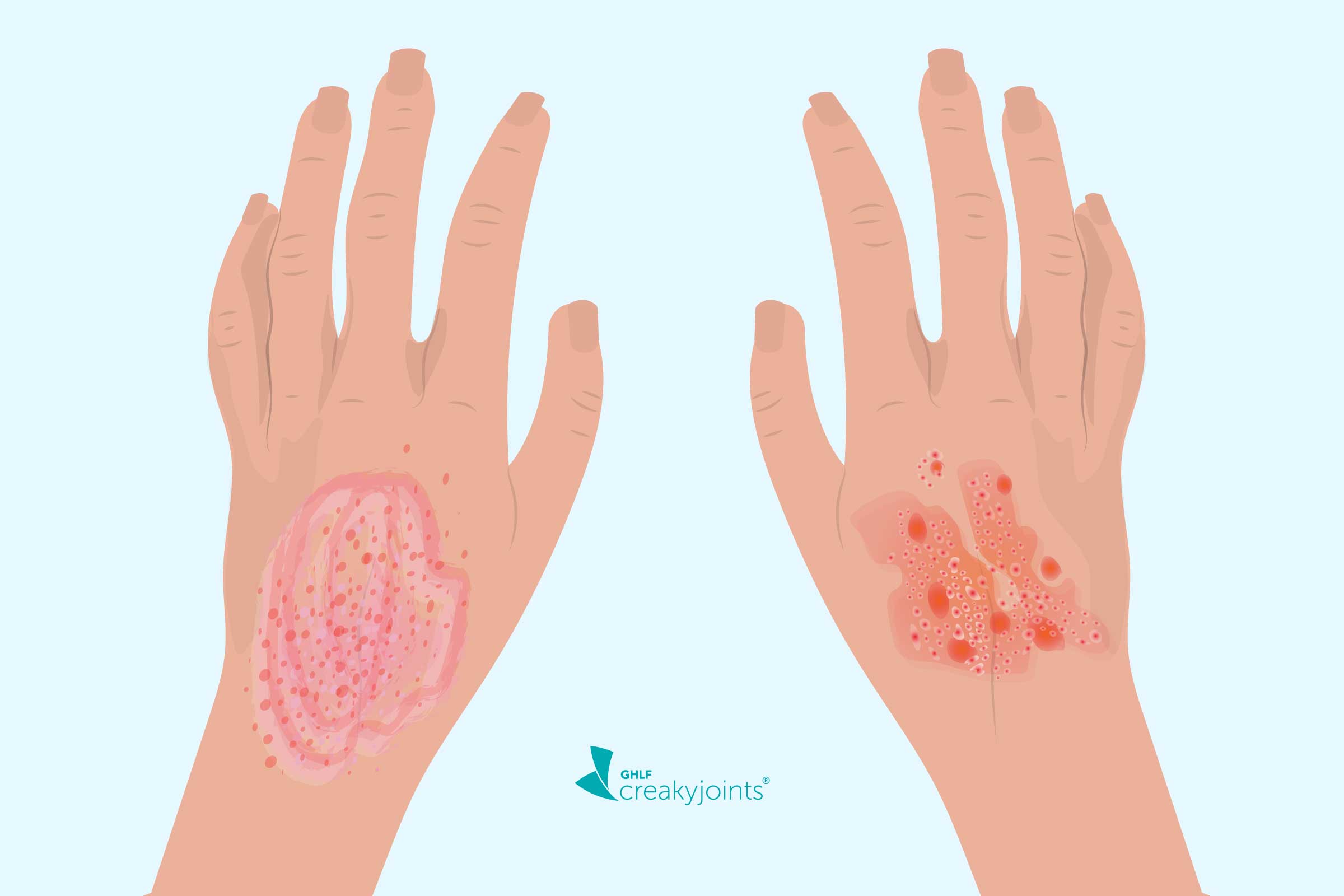 Eczema Vs Psoriasis Logo 