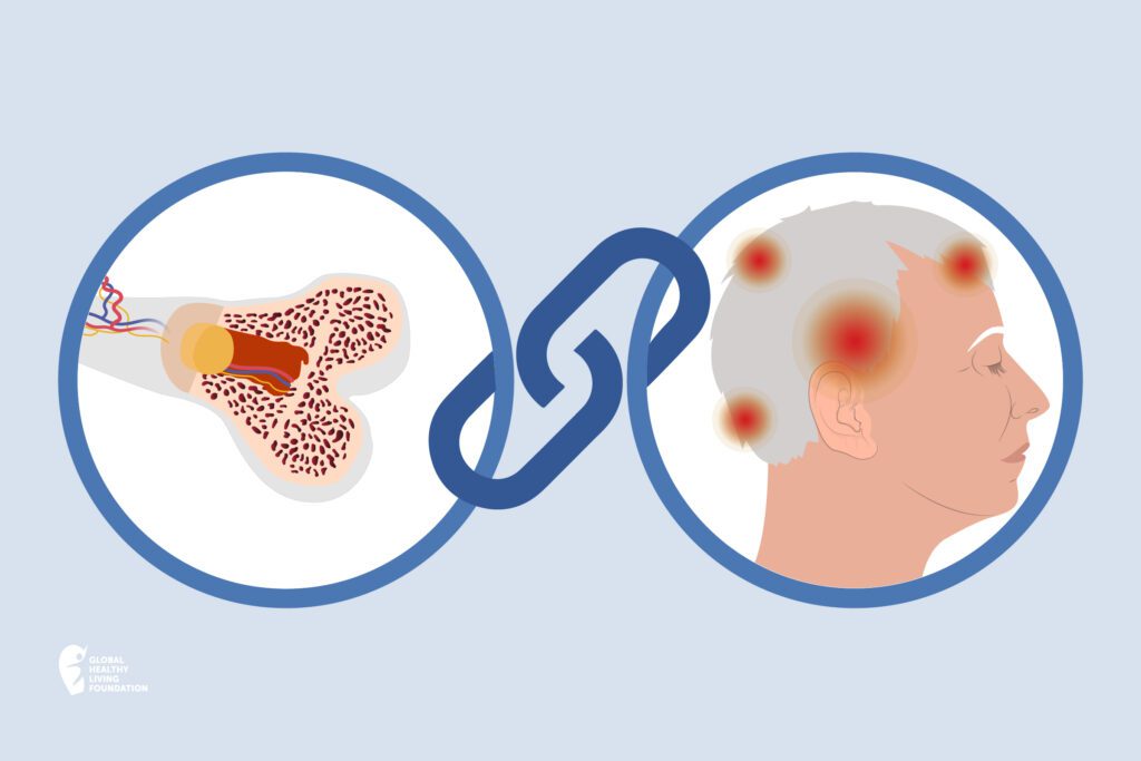 cartoon of two circles and link showing osteoporosis and migraine