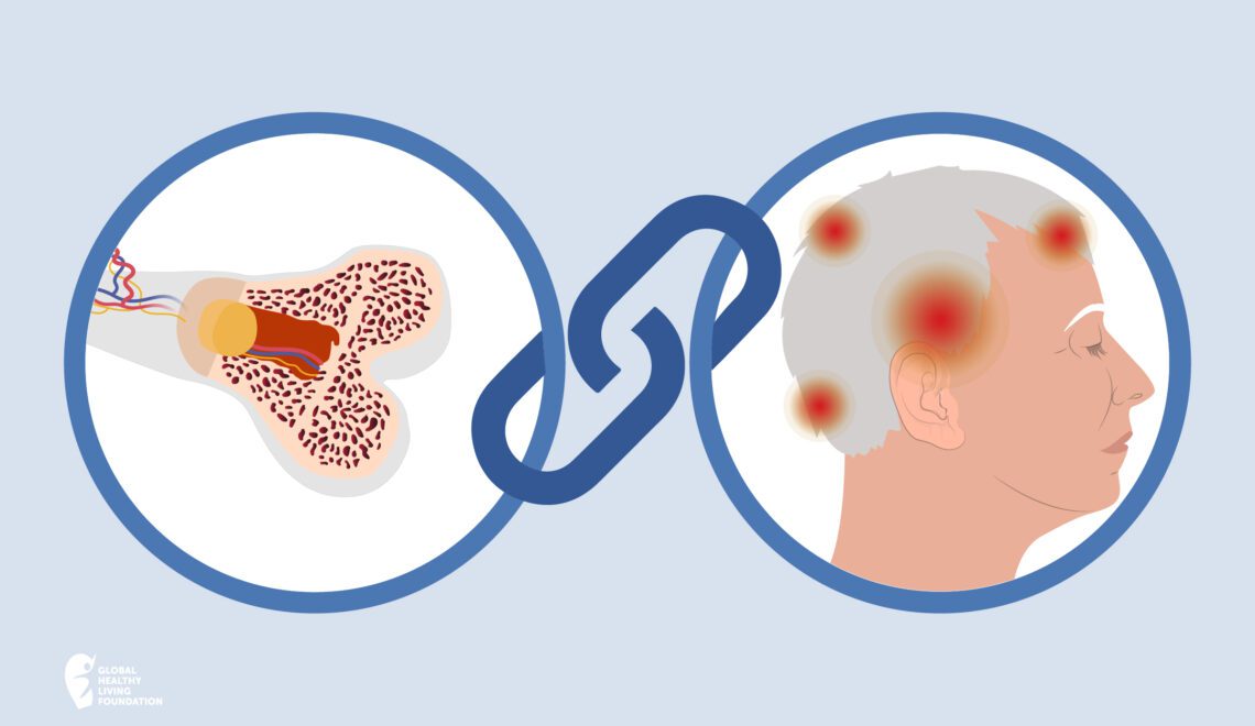 cartoon of two circles and link showing osteoporosis and migraine