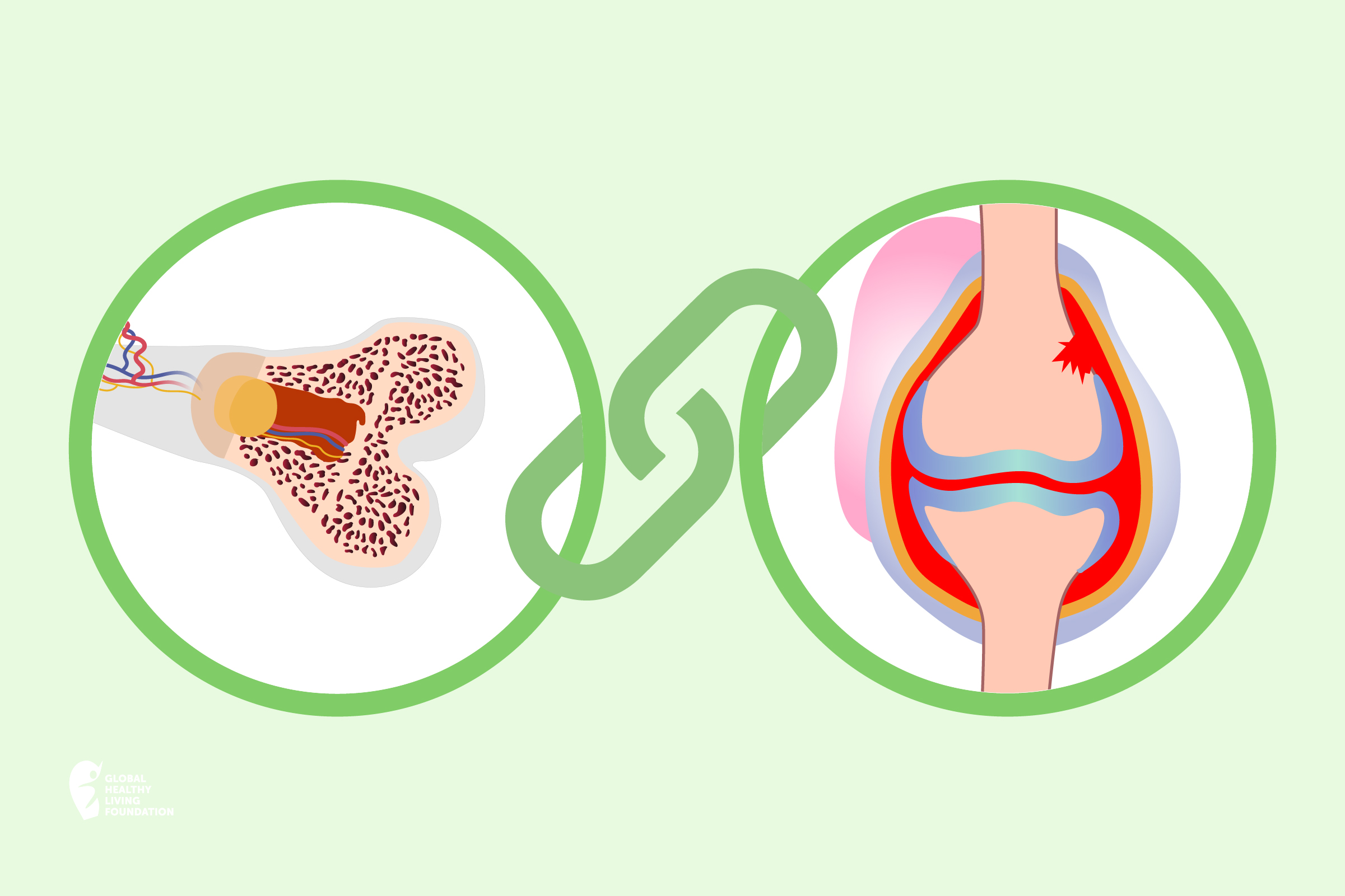 Physical Activity is Important to Osteoarthritis - Osteoarthritis