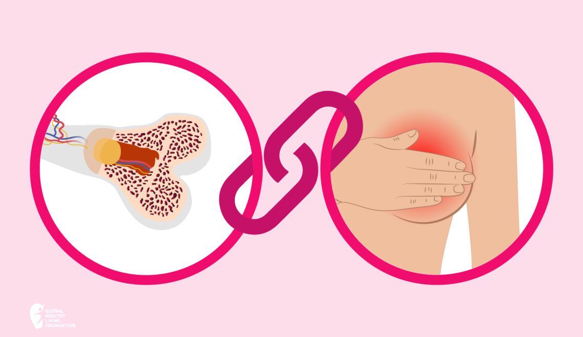 Illustration showing link between osteoporosis and cancer