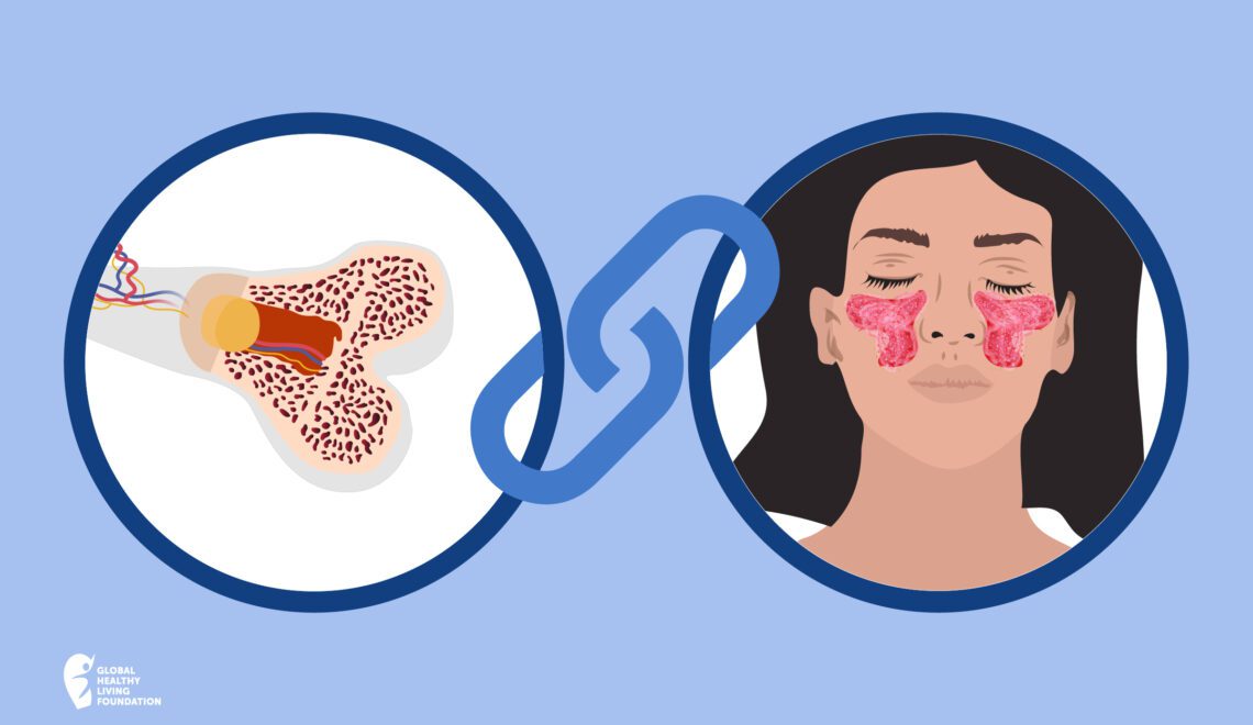 Cartoon illustration showing osteoporosis and lupus